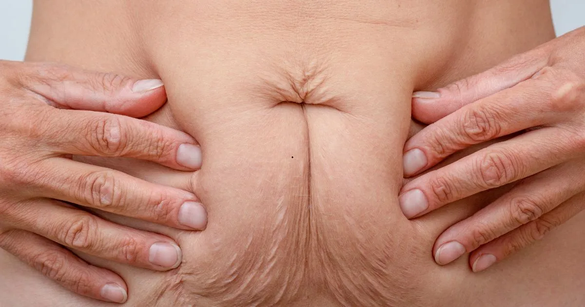 How to Tighten Skin After Weight Loss Naturally