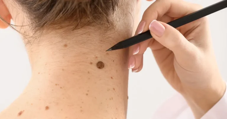 Use a Natural Skin Tag Remover