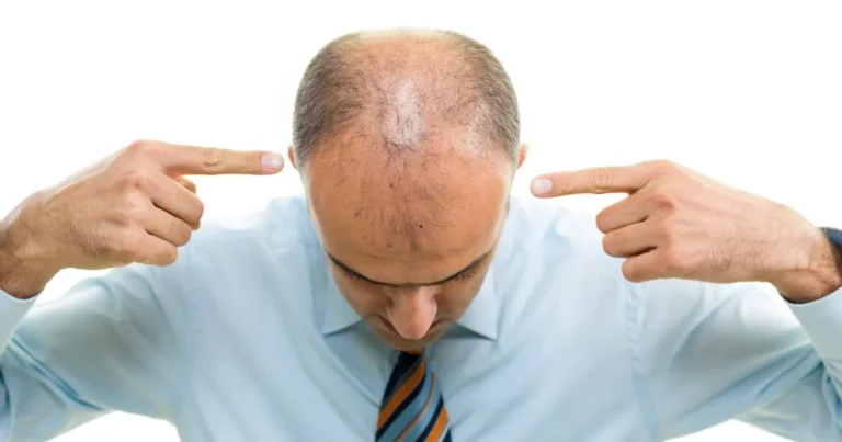 Does Testosterone Cause Hair Loss in Men? What You Need to Know